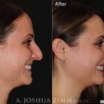Rhinoplastyleftside20205