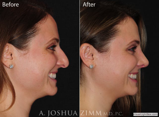 Rhinoplastyleftside20205