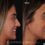 Rhinoplastyleftside20214