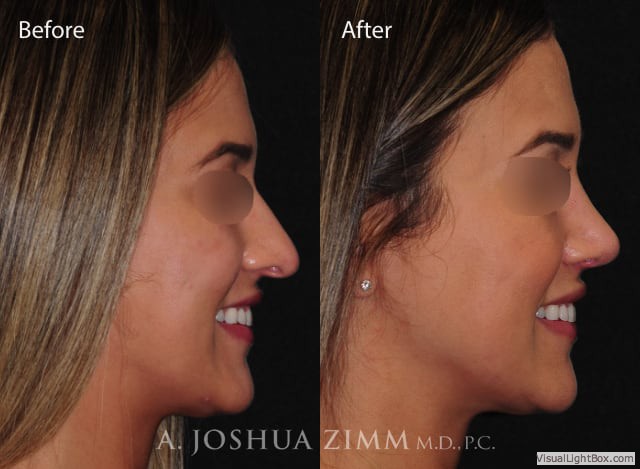 Rhinoplastyleftside20214