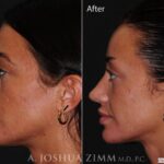 Rhinoplastyleftside2021866m
