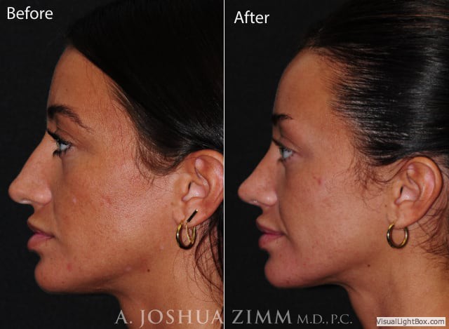 Rhinoplastyleftside2021866m