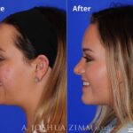 Rhinoplastyright190 1