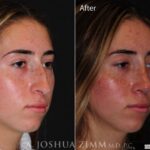 Rhinoplastyrightoblique2021821m
