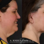 02_Facelift_before_after