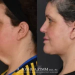 04_Facelift_before_after