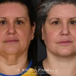 07_Facelift_before_after.png