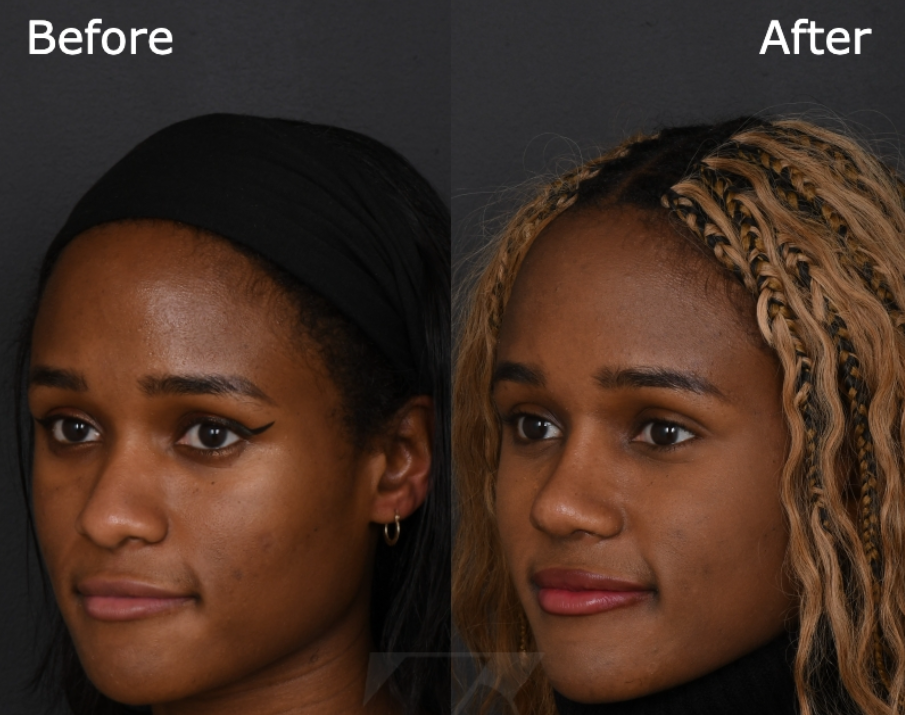 This New York City patient underwent a rhinoplasty by Dr. Joshua Zimm. The side-by-side comparison shows how her nose shape was re-contoured in a subtle, yet dramatic way.