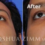Man’s face from below before and after rhinoplasty.