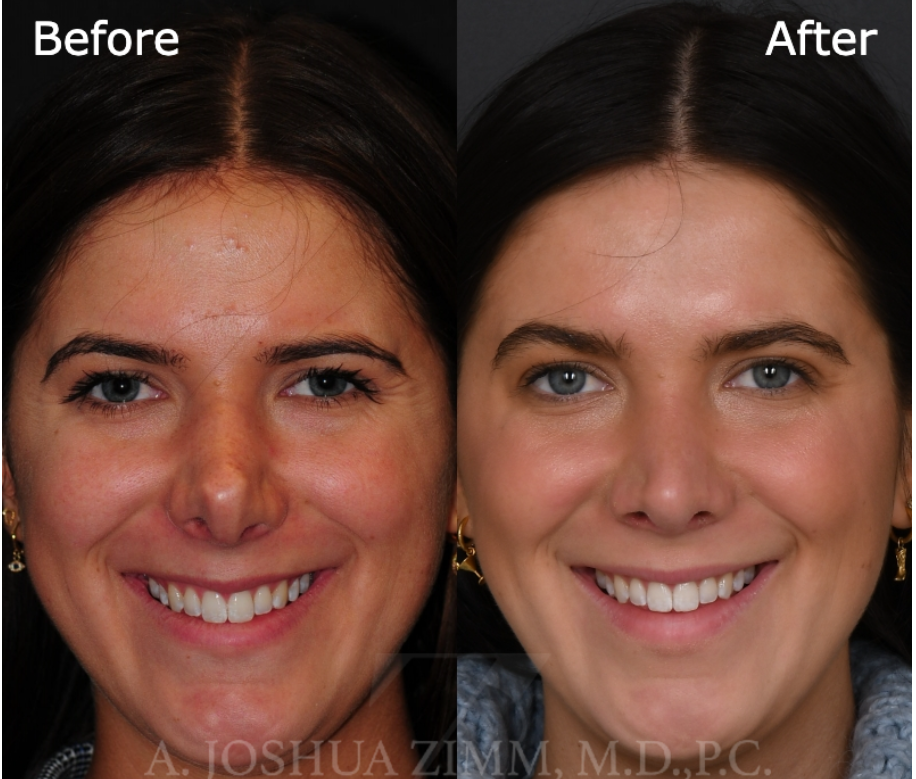 This patient shows side-by-side the before and after results from her revision rhinoplasty performed by Dr. Joshua Zimm in New York.