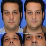 rhinoplasty before and after photo