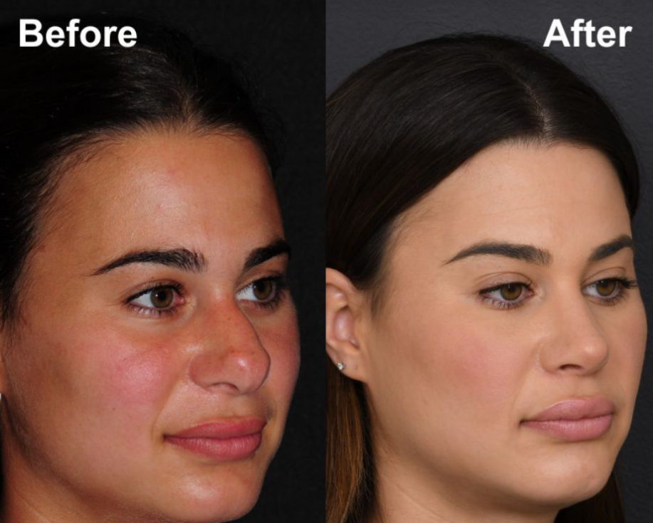Featured before and after results of a New York rhinoplasty patient.