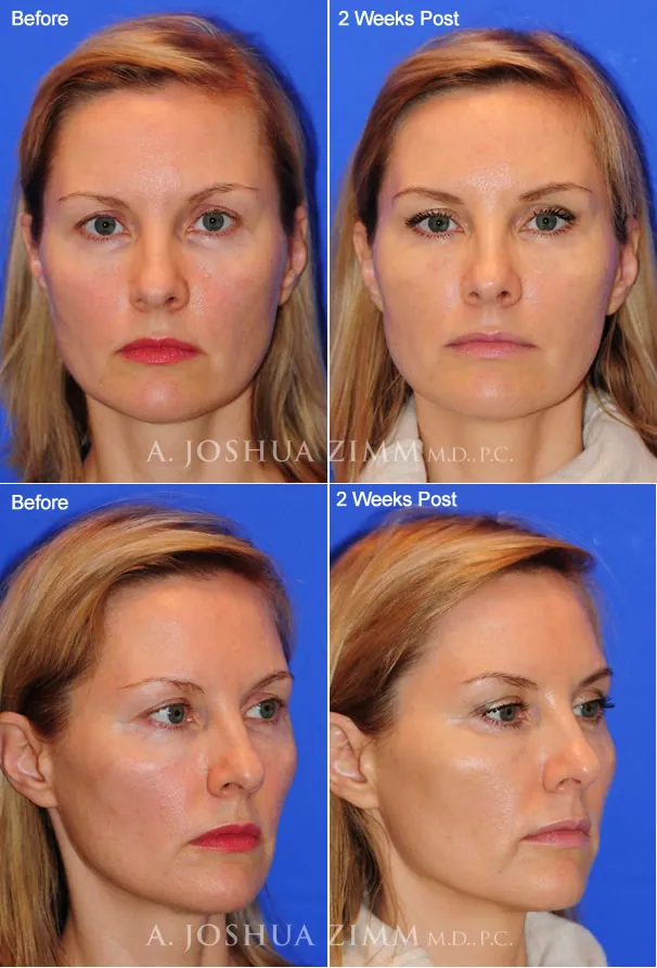 voluma1