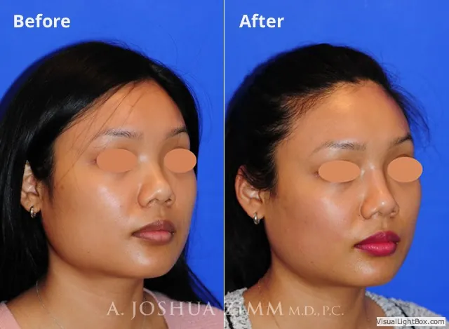 injectablerhinoplasty20162