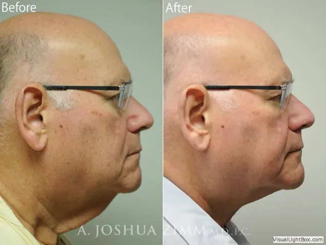 necklift2