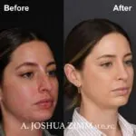 Rhinoplasty - Before and After