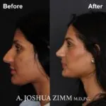 Rhinoplasty - Before and After