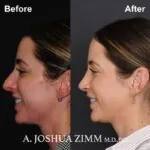 Rhinoplasty - Before and After