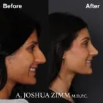 Rhinoplasty - Before and After