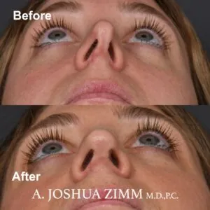 1-revision-rhinoplasty Revision Rhinoplasty - Before and After