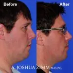 FaceTite / AccuTite - Before and After
