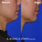 FaceTite / AccuTite - Before and After