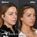 Revision Rhinoplasty - Before and After