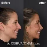 Rhinoplasty Before and After