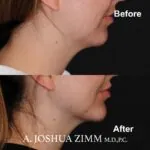 Chin implant - before and after