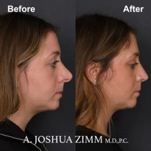 7-revision-rhinoplasty Revision Rhinoplasty - Before and After
