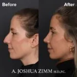 Rhinoplasty Before and After
