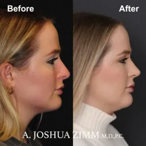 8-revision-rhinoplasty Revision Rhinoplasty - Before and After