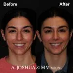 Chin implant - before and after