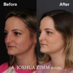 Rhinoplasty - before and after