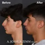 Rhinoplasty - before and after