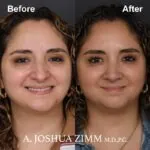 Rhinoplasty - before and after