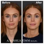 Rhinoplasty - before and after