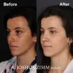 Rhinoplasty - before and after