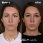Rhinoplasty - before and after