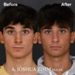 Rhinoplasty - before and after