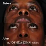 Rhinoplasty - before and after