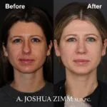 Rhinoplasty - before and after