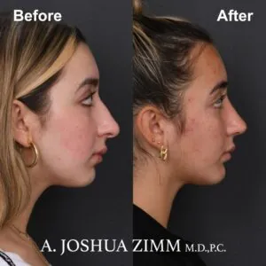 2-rhinoplasty-before-and-after Rhinoplasty - before and after