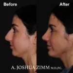 Chin implant - before and after