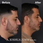 Chin implant - before and after