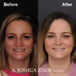 Rhinoplasty - before and after