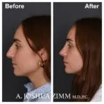 Rhinoplasty - before and after