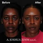 Rhinoplasty - before and after