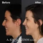 Rhinoplasty - before and after