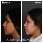 Rhinoplasty - before and after